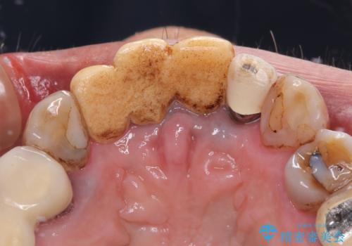 仮歯が汚くて転院 前歯のオールセラミッククラウン治療の治療前