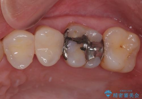 銀歯がとれた セラミックインレー修復の治療後