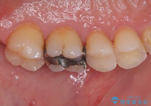 銀歯がとれた セラミックインレー修復の治療後