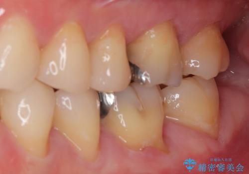 銀歯がとれた セラミックインレー修復の治療後