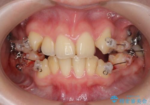 歯並びのせいで歯ブラシがしづらい マルチブラケットを用いた抜歯矯正の治療前
