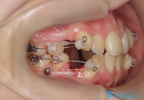 歯並びのせいで歯ブラシがしづらい マルチブラケットを用いた抜歯矯正の治療前