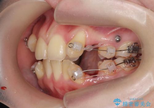 歯並びのせいで歯ブラシがしづらい マルチブラケットを用いた抜歯矯正の治療前