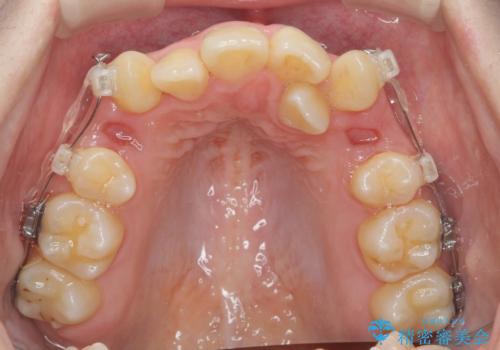 歯並びのせいで歯ブラシがしづらい　マルチブラケットを用いた抜歯矯正の治療前