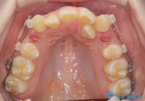 歯並びのせいで歯ブラシがしづらい マルチブラケットを用いた抜歯矯正の治療前
