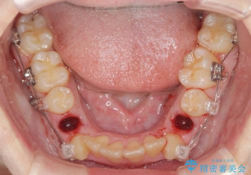 歯並びのせいで歯ブラシがしづらい マルチブラケットを用いた抜歯矯正の治療前
