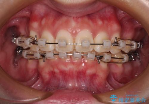 口元が出ているのを改善したい。 クリアブラケットによる抜歯矯正の治療中