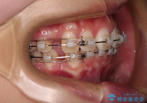 口元が出ているのを改善したい。　クリアブラケットによる抜歯矯正の治療中