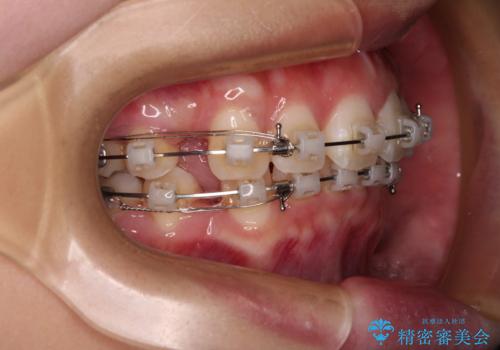 口元が出ているのを改善したい。 クリアブラケットによる抜歯矯正の治療中