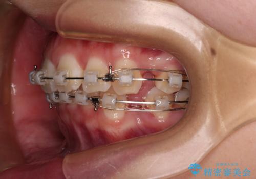 口元が出ているのを改善したい。 クリアブラケットによる抜歯矯正の治療中