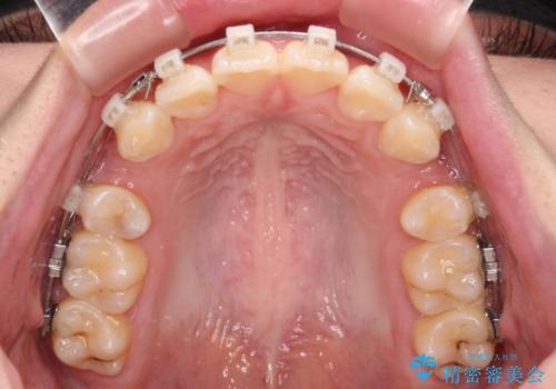 口元が出ているのを改善したい。　クリアブラケットによる抜歯矯正の治療中