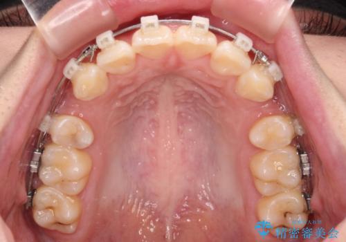 口元が出ているのを改善したい。 クリアブラケットによる抜歯矯正の治療中