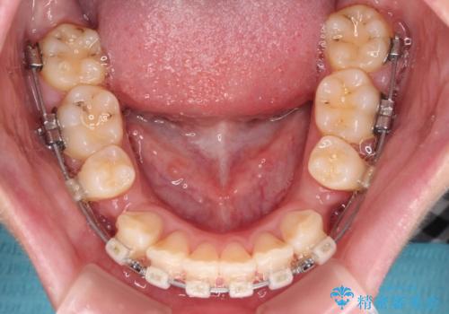 口元が出ているのを改善したい。 クリアブラケットによる抜歯矯正の治療中