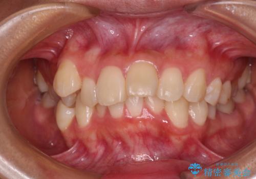 唇を閉じてもはみ出してしまう上顎前歯 抜歯矯正で口元を改善の症例 治療前