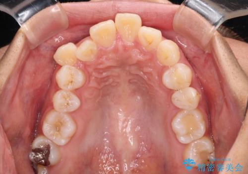 唇を閉じてもはみ出してしまう上顎前歯　抜歯矯正で口元を改善の治療前