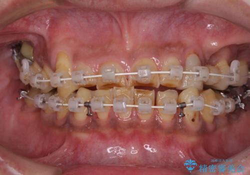 反対咬合ですり減った前歯とむし歯だらけの奥歯 総合歯科治療の治療中