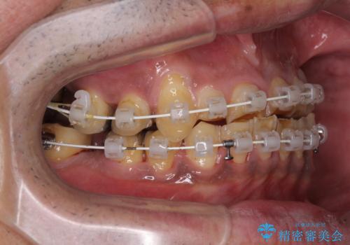反対咬合ですり減った前歯とむし歯だらけの奥歯 総合歯科治療の治療中