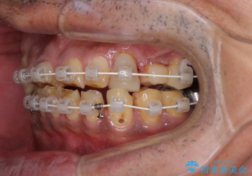 反対咬合ですり減った前歯とむし歯だらけの奥歯 総合歯科治療の治療中