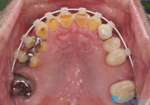 反対咬合ですり減った前歯とむし歯だらけの奥歯 総合歯科治療の治療中
