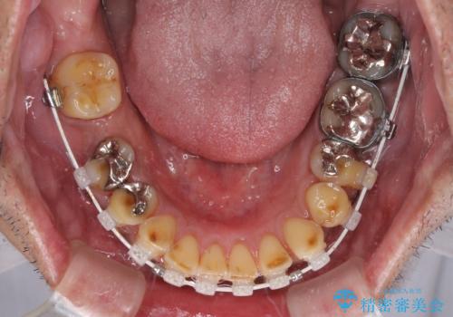 反対咬合ですり減った前歯とむし歯だらけの奥歯 総合歯科治療の治療中