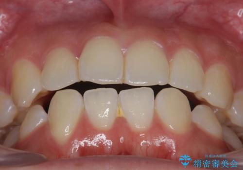先天性の2歯欠損 個性を活かしたマウスピース矯正の治療後