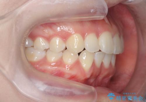 先天性の2歯欠損 個性を活かしたマウスピース矯正の治療後