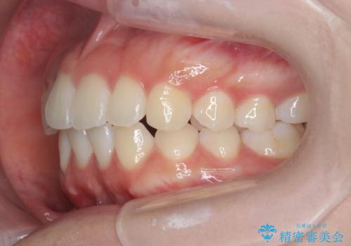 先天性の2歯欠損 個性を活かしたマウスピース矯正の治療後