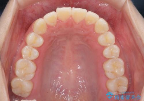 先天性の2歯欠損  個性を活かしたマウスピース矯正の治療後