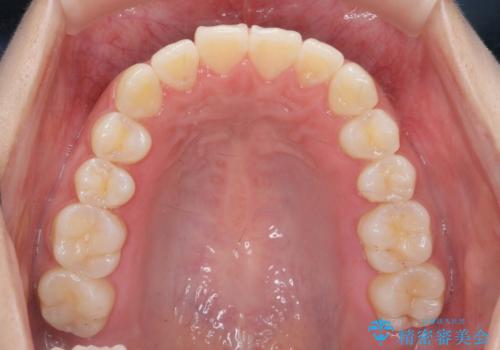 先天性の2歯欠損 個性を活かしたマウスピース矯正の治療後