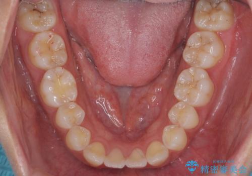 先天性の2歯欠損 個性を活かしたマウスピース矯正の治療後