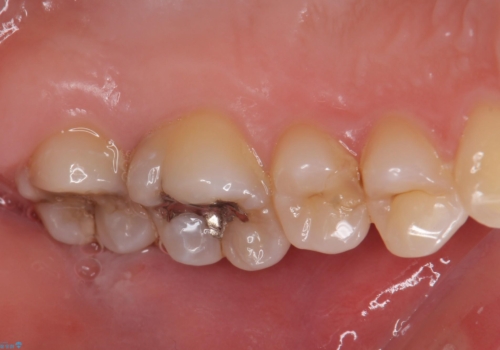 奥歯の虫歯の治療　の治療前