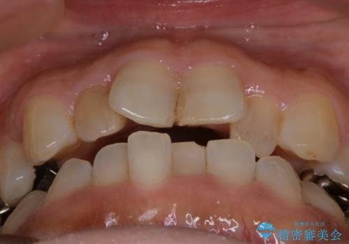 審美性と機能を改善! インビザライン矯正の治療前