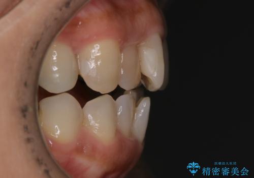 審美性と機能を改善! インビザライン矯正の治療前