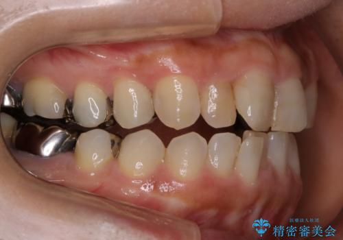 審美性と機能を改善! インビザライン矯正の治療前