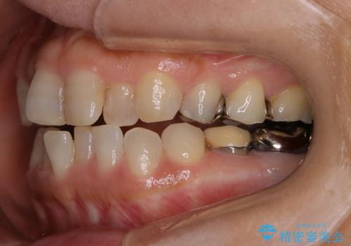 審美性と機能を改善! インビザライン矯正の治療前