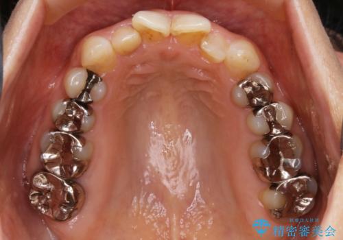 審美性と機能を改善! インビザライン矯正