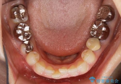 審美性と機能を改善! インビザライン矯正の治療前