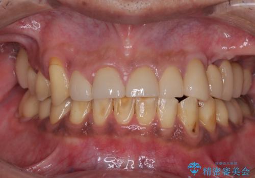 反対咬合ですり減った前歯とむし歯だらけの奥歯 総合歯科治療の症例 治療後
