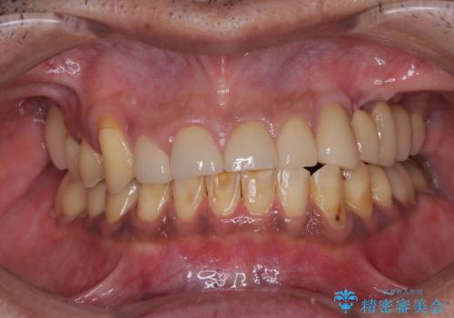 反対咬合ですり減った前歯とむし歯だらけの奥歯　総合歯科治療