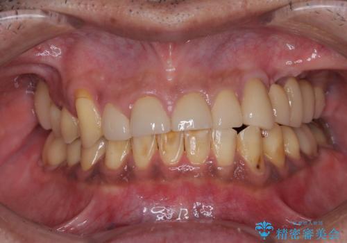 反対咬合ですり減った前歯とむし歯だらけの奥歯 総合歯科治療