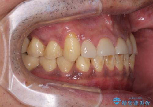 反対咬合ですり減った前歯とむし歯だらけの奥歯 総合歯科治療の治療後