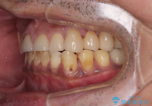 反対咬合ですり減った前歯とむし歯だらけの奥歯 総合歯科治療の治療後