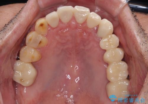 反対咬合ですり減った前歯とむし歯だらけの奥歯 総合歯科治療の治療後