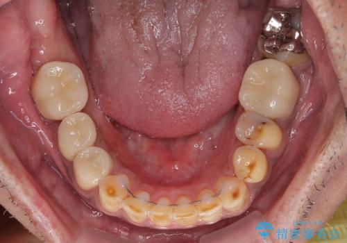 反対咬合ですり減った前歯とむし歯だらけの奥歯 総合歯科治療の治療後