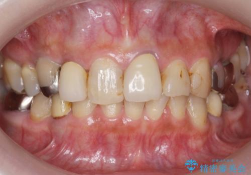 50代女性 銀歯をとって白いつめものに 全体的な治療の症例 治療前