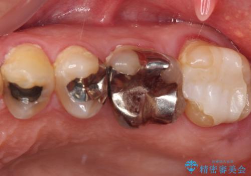 食べ物がよくはさまるのが気になる。オールセラミッククラウンによる補綴治療の症例 治療前