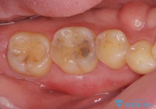 セラミックインレー。の治療前