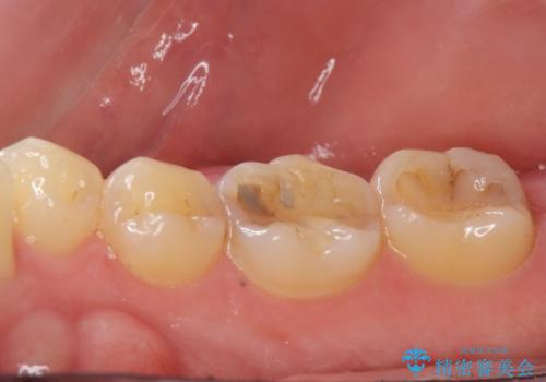 セラミックインレー。の治療前