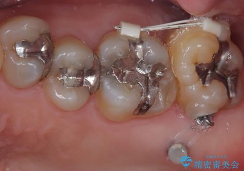 外側に飛び出している歯 部分矯正を用いた奥歯の補綴治療の治療中