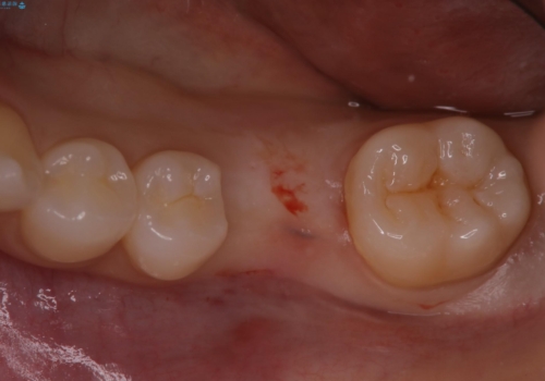 奥歯が残せないと言われた。『インプラント治療』の治療中